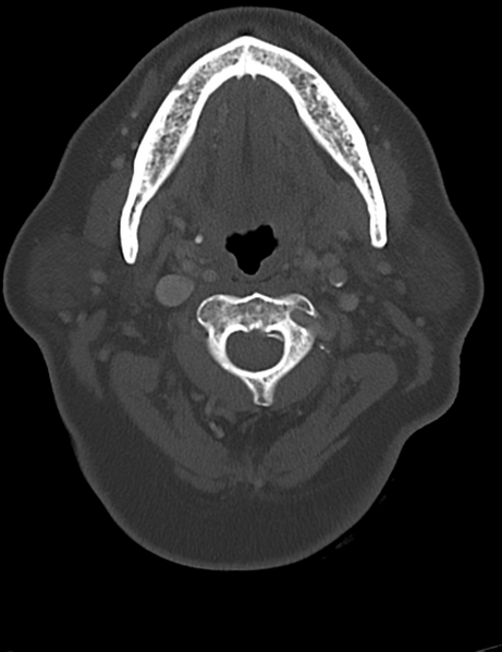 File:Causes of dysphagia (Radiopaedia 40149-42657 Axial bone window 22).png