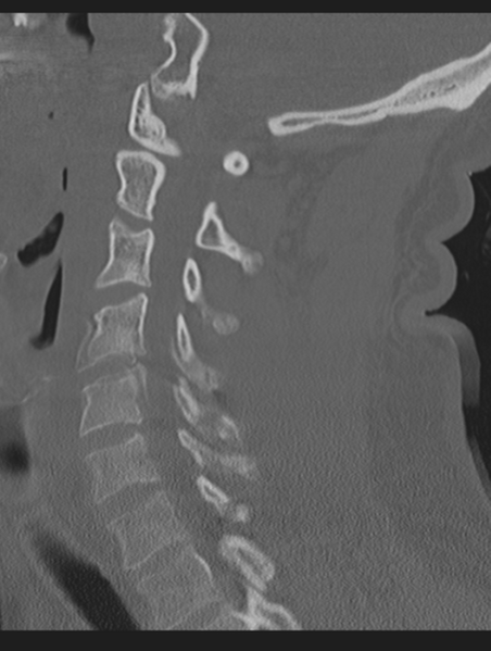 File:Cavernoma of cervical cord (Radiopaedia 50838-56346 Sagittal bone window 47).png
