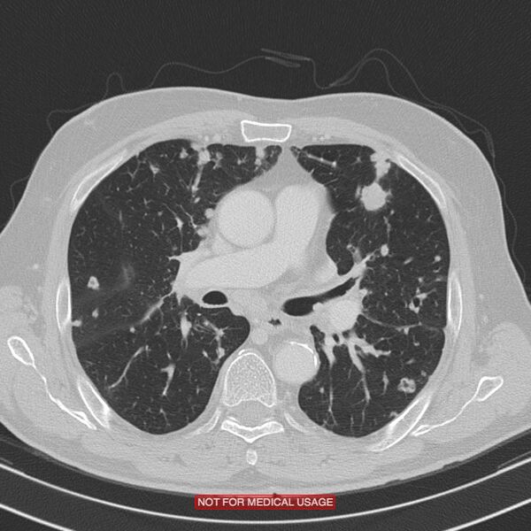File:Cavitating pulmonary metastases (Radiopaedia 24920-25184 Axial lung window 10).jpg