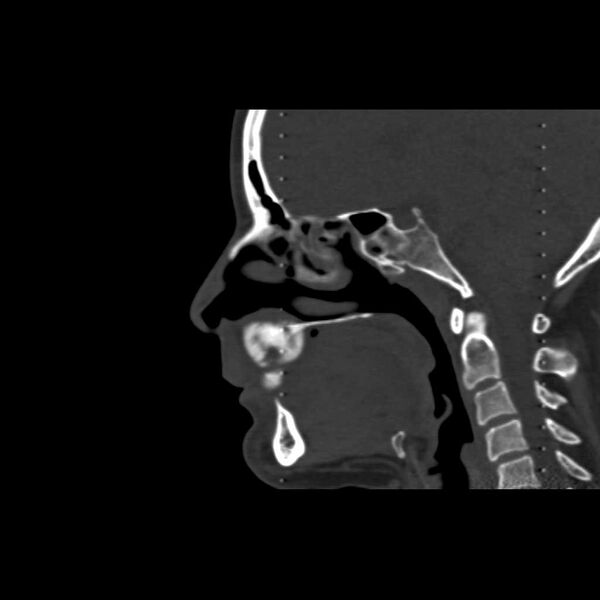 File:Cemento-ossifying fibroma (Radiopaedia 21243-21149 Sagittal bone window 8).jpg