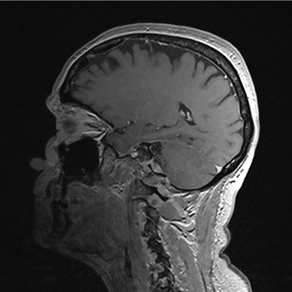 File:Central base of skull meningioma (Radiopaedia 53531-59549 Sagittal T1 C+ 1).jpg