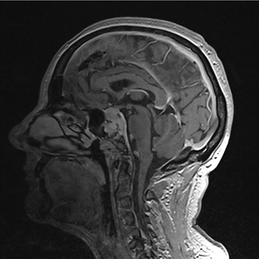 Central base of skull meningioma (Radiopaedia 53531-59549 Sagittal T1 C+ 26).jpg