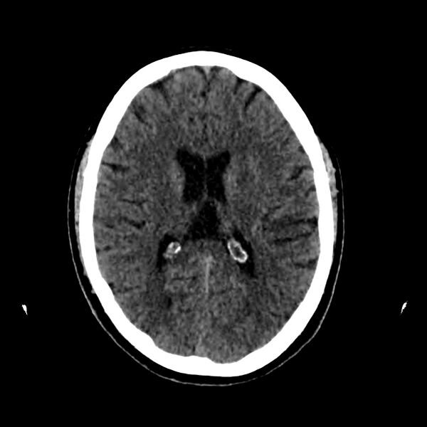 File:Central nervous system Langerhans cell histiocytosis (Radiopaedia 65728-74878 Axial non-contrast 31).jpg