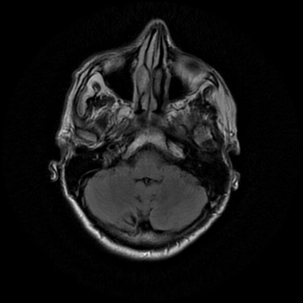 File:Central neurocytoma (Radiopaedia 67618-77021 Axial FLAIR 6).jpg