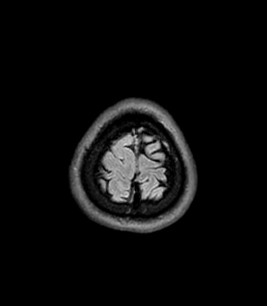 File:Central neurocytoma (Radiopaedia 79320-92380 Axial FLAIR 42).jpg