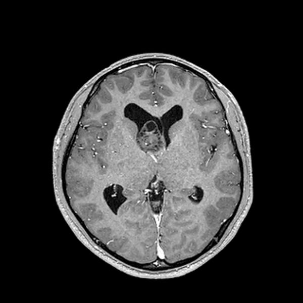 File:Central neurocytoma (Radiopaedia 79320-92380 Axial T1 C+ 125).jpg