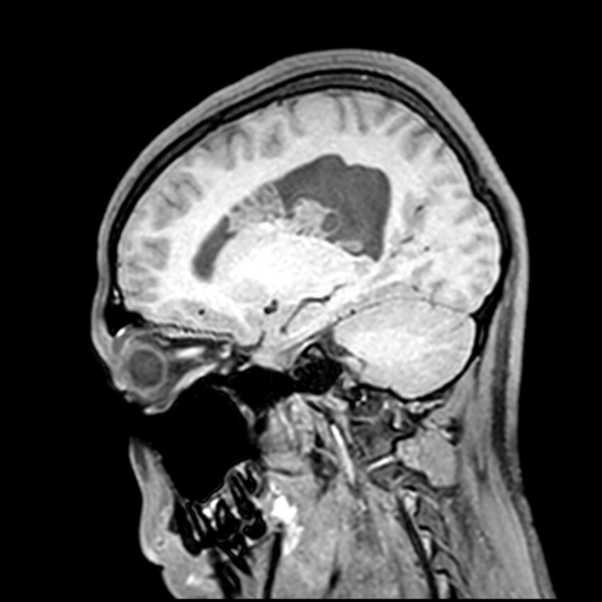 Central neurocytoma (Radiopaedia 79320-92380 Sagittal T1 167).jpg