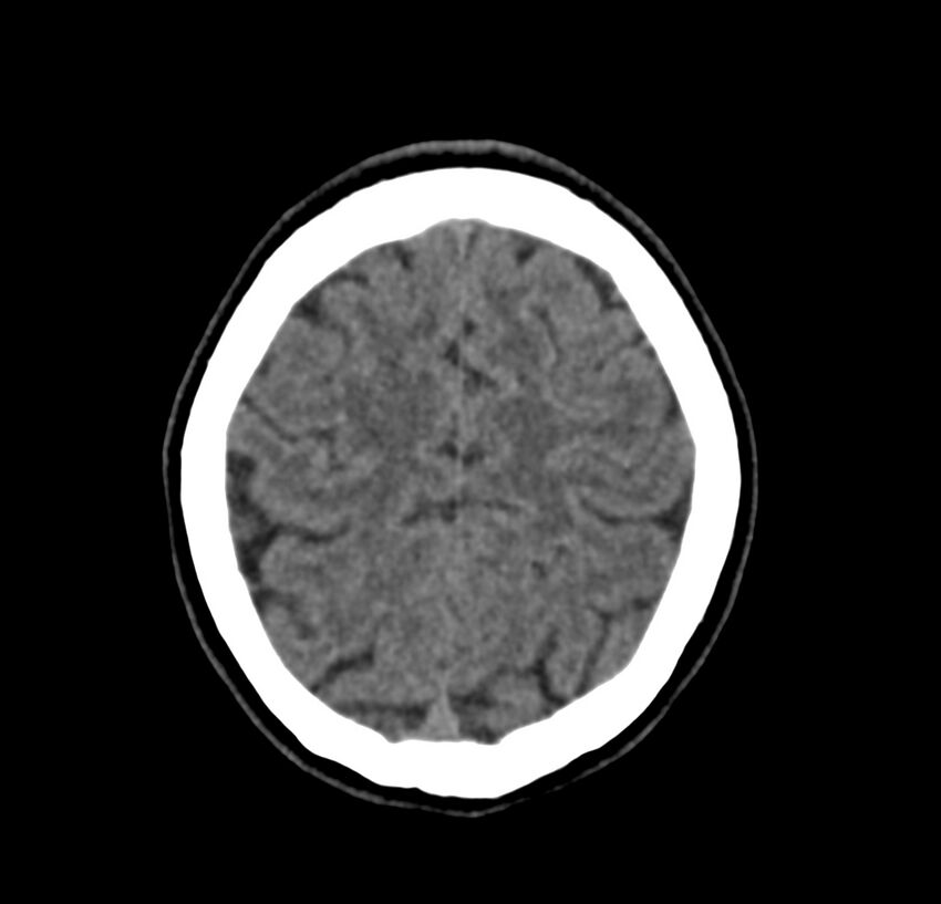 Cerebellar agenesis (Radiopaedia 30203-30817 Axial non-contrast 41).jpg