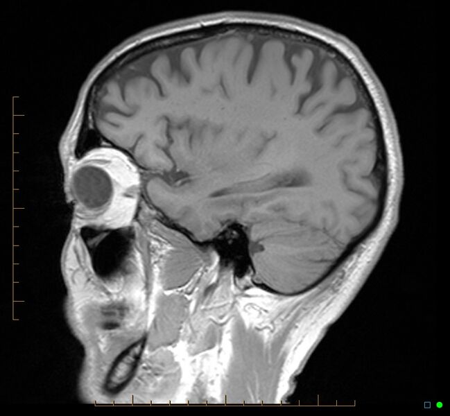 File:Cerebellar gangliocytoma (Radiopaedia 65377-74422 Sagittal T1 32).jpg