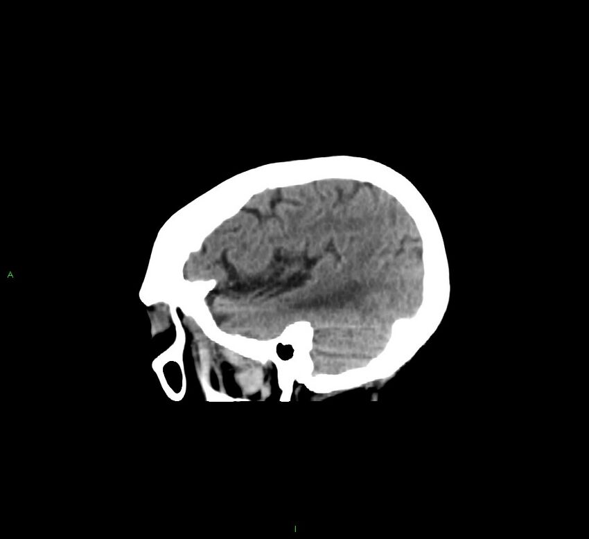 Cerebellar hemorrhage (Radiopaedia 58793-66027 C 41).jpg