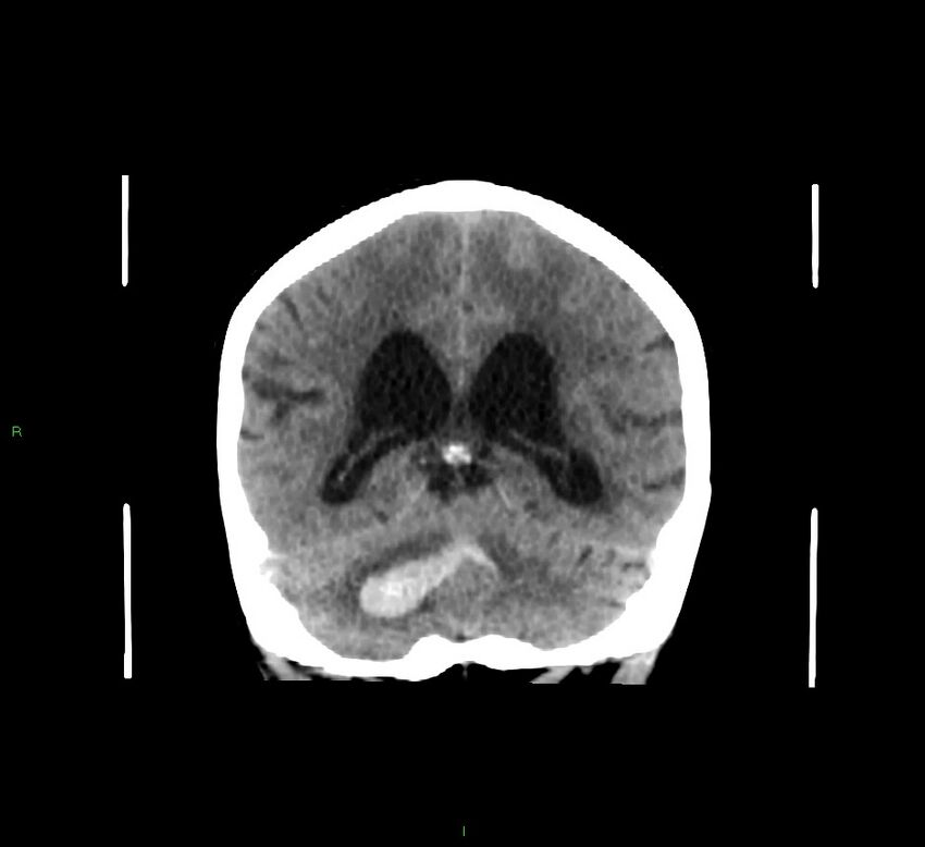 Cerebellar hemorrhage (Radiopaedia 58793-66027 Coronal non-contrast 27).jpg