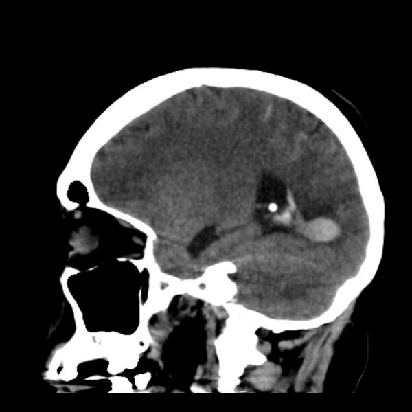 File:Cerebellar hemorrhage causing obstructive hydrocephalus (Radiopaedia 33989-35207 B 32).jpg