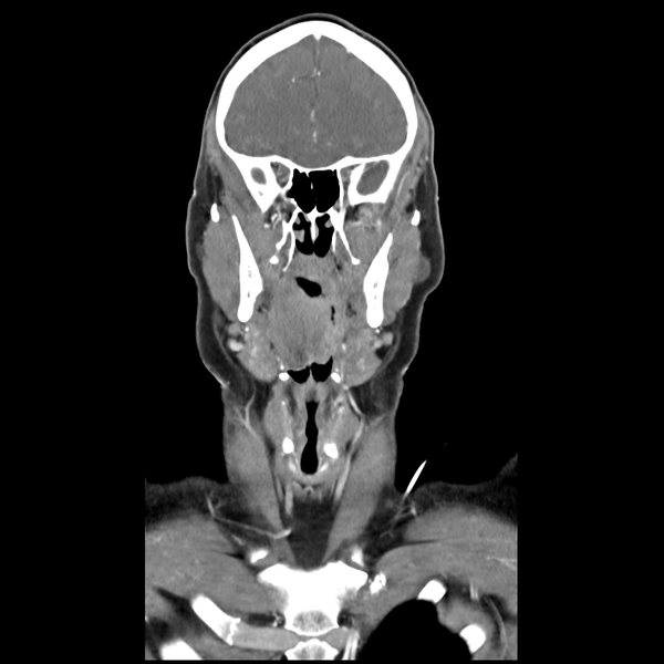 File:Cerebellar infarct due to vertebral artery dissection with posterior fossa decompression (Radiopaedia 82779-97029 D 19).png