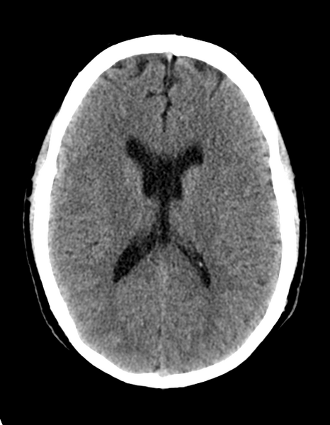 File:Cerebellar infarct due to vertebral artery dissection with posterior fossa decompression (Radiopaedia 82779-97030 Axial non-contrast 20).png