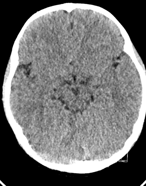 File:Cerebellar stroke (Radiopaedia 32202-33149 Axial non-contrast 9).png