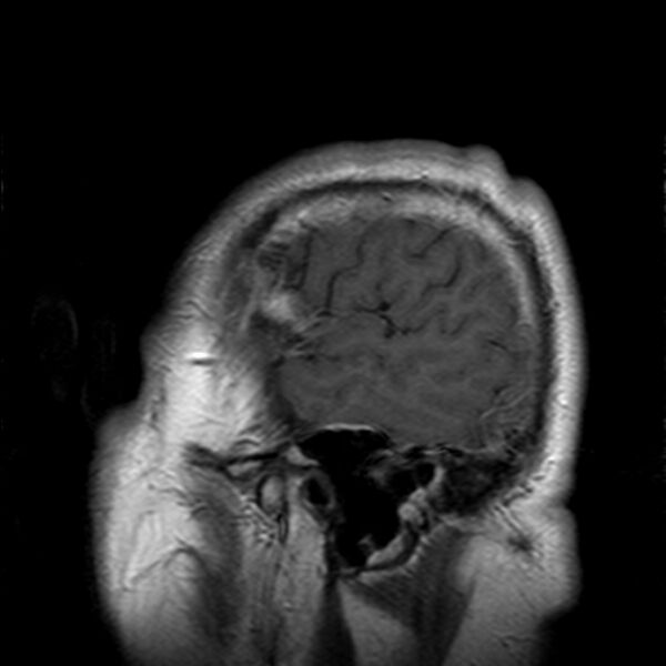 File:Cerebellopontine angle meningioma (Radiopaedia 24459-24764 Sagittal T1 C+ 24).jpg