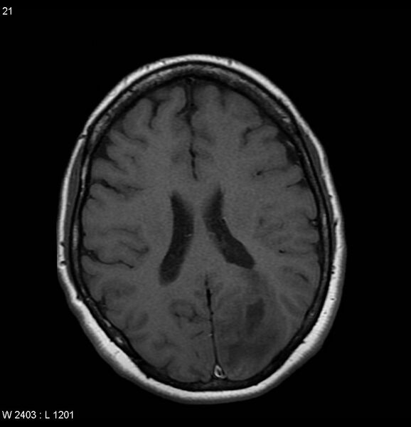 File:Cerebral abscess - shaggy borders (Radiopaedia 5492-7225 Axial T1 1).jpg