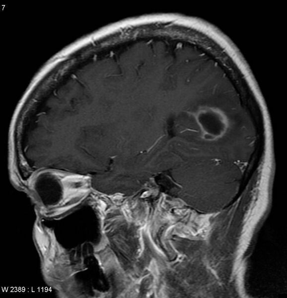File:Cerebral abscess - shaggy borders (Radiopaedia 5492-7225 Sagittal T1 C+ 1).jpg