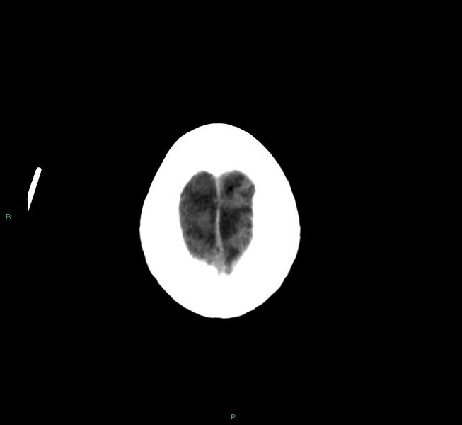File:Cerebral amyloid angiopathy-associated lobar intracerebral hemorrhage (Radiopaedia 58376-65513 Axial non-contrast 5).jpg