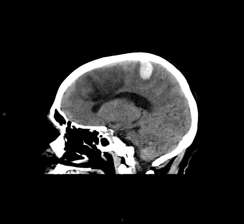 Cerebral amyloid angiopathy-associated lobar intracerebral hemorrhage (Radiopaedia 58529-65681 B 29).jpg