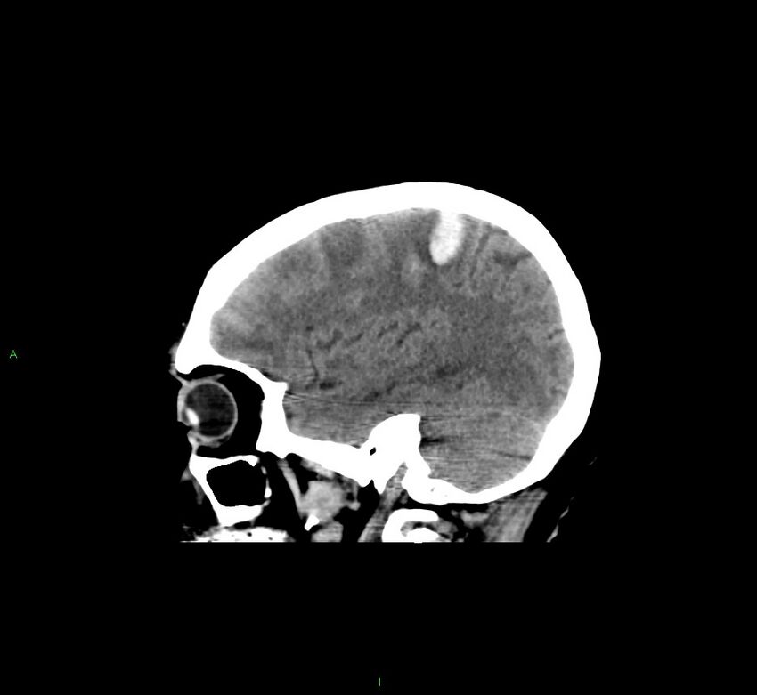 Cerebral amyloid angiopathy-associated lobar intracerebral hemorrhage (Radiopaedia 58529-65681 B 36).jpg