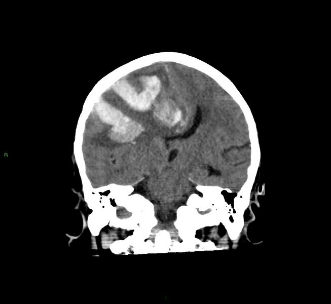 File:Cerebral amyloid angiopathy-associated lobar intracerebral hemorrhage (Radiopaedia 58560-65723 Coronal non-contrast 36).jpg