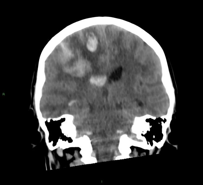 File:Cerebral amyloid angiopathy-associated lobar intracerebral hemorrhage (Radiopaedia 58566-65730 Coronal non-contrast 33).jpg