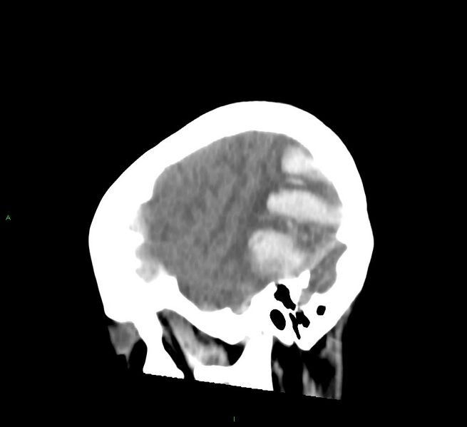 File:Cerebral amyloid angiopathy-associated lobar intracerebral hemorrhage (Radiopaedia 58754-65975 C 40).jpg