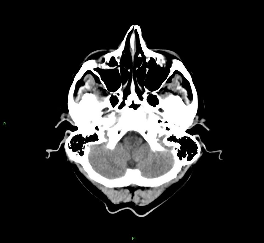 Cerebral amyloid angiopathy-associated lobar intracerebral hemorrhage (Radiopaedia 58756-65977 Axial non-contrast 45).jpg