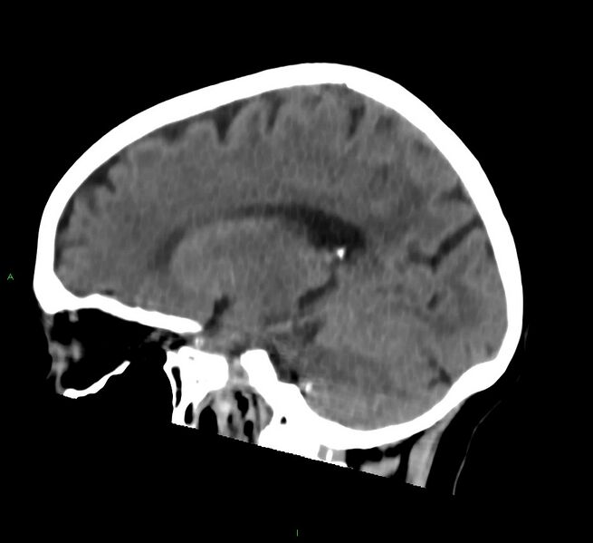 File:Cerebral amyloid angiopathy-associated lobar intracerebral hemorrhage (Radiopaedia 58757-65978 C 33).jpg