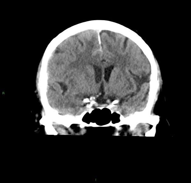 File:Cerebral amyloid angiopathy-associated lobar intracerebral hemorrhage (Radiopaedia 59356-66716 Coronal non-contrast 41).jpg