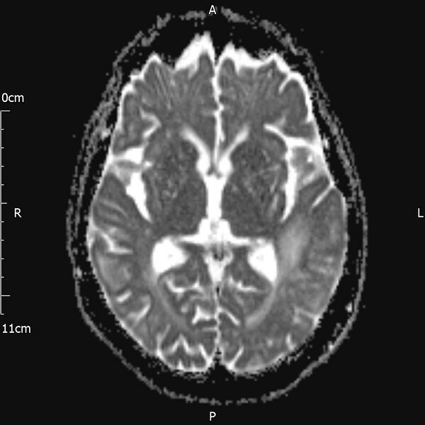 File:Cerebral amyloid angiopathy related inflammation (Radiopaedia 72772-83415 Axial ADC 12).jpg