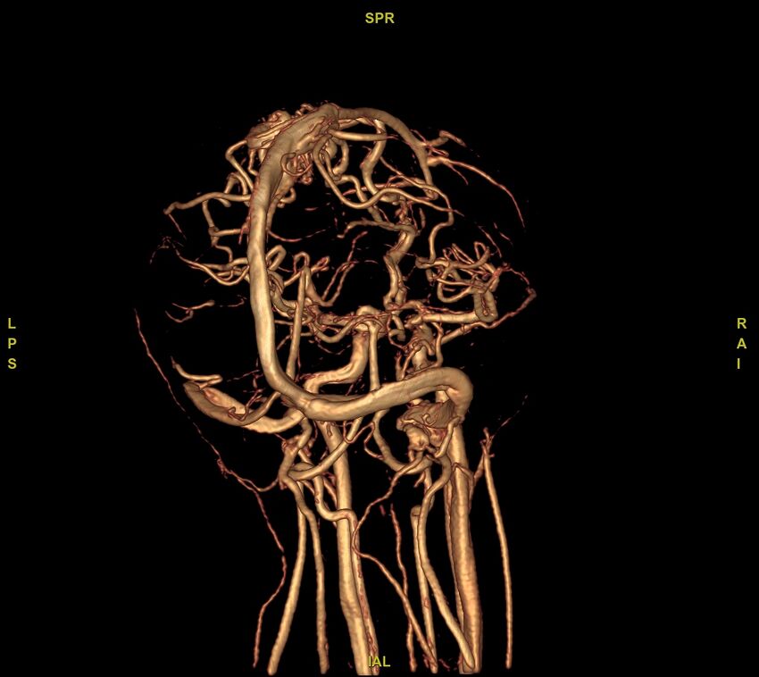 Cerebral arteriovenous malformation (Radiopaedia 61964-70029 VRT 19).jpg