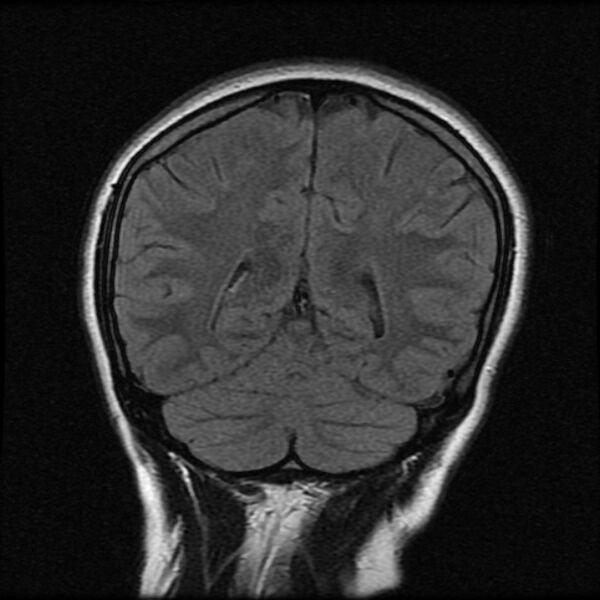 File:Cerebral cavernous malformation (Radiopaedia 44301-47942 Coronal FLAIR 19).jpg