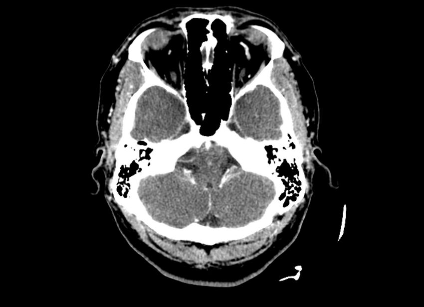 Cerebral edema (Radiopaedia 82519-96661 B 46).jpg