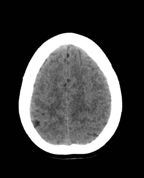 File:Cerebral edema due to severe hyponatremia (Radiopaedia 89826-106938 Axial non-contrast 84).jpg