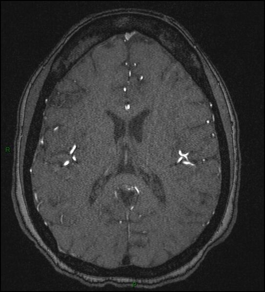 File:Cerebral fat embolism (Radiopaedia 35022-36525 Axial TOF 124).jpg
