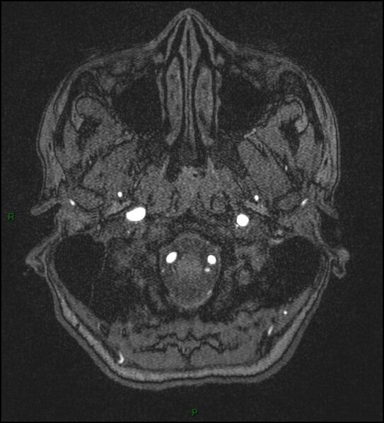 File:Cerebral fat embolism (Radiopaedia 35022-36525 Axial TOF 9).jpg