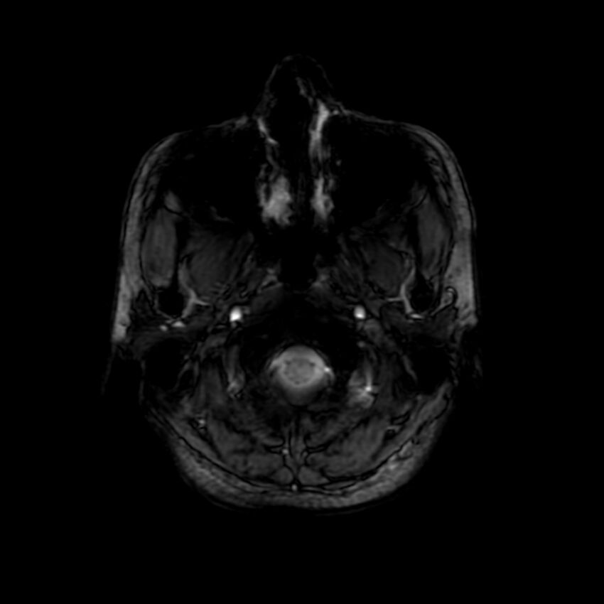 Cerebral paragonimiasis (Radiopaedia 73473-84238 Axial SWI 4).jpg