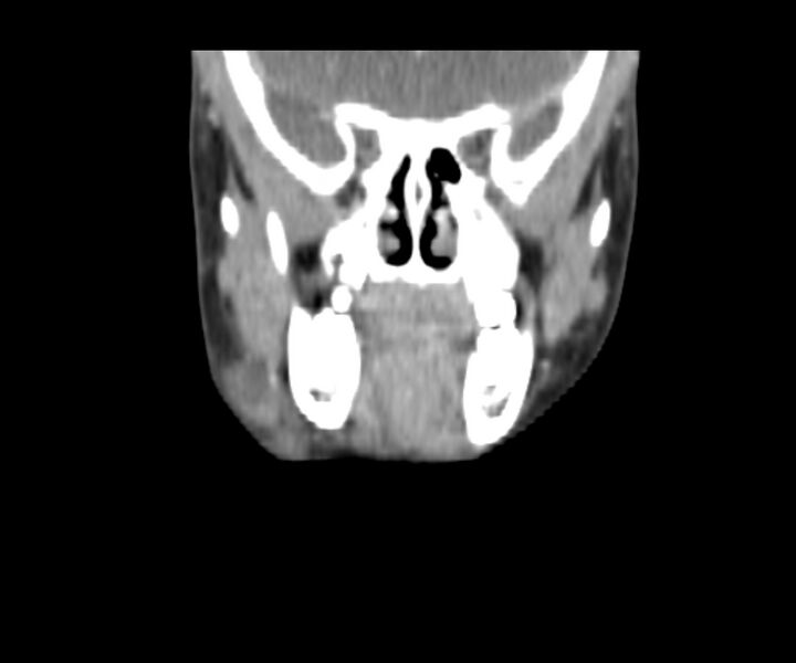 File:Cervical cystic lymphangioma (Radiopaedia 63655-72332 Coronal + contrast 13).jpg