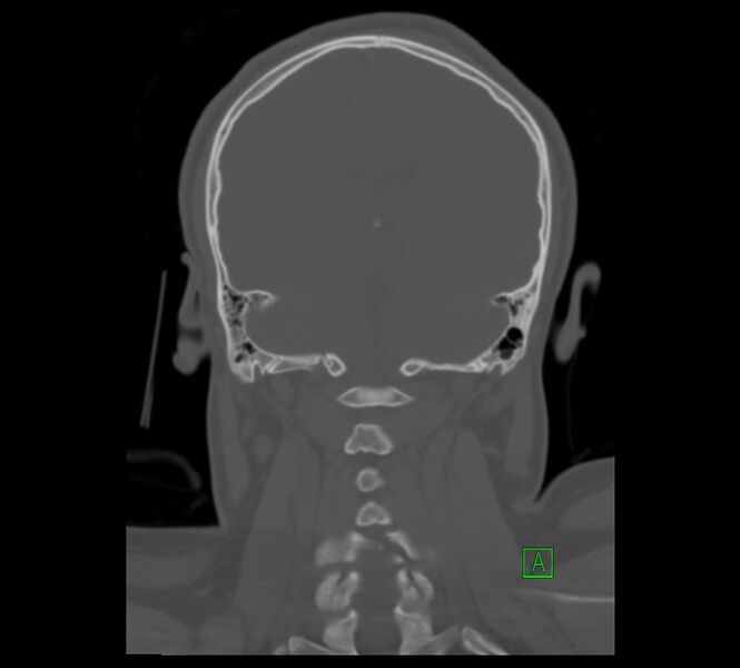 File:Cervical spine fracture - hyperflexion injury (Radiopaedia 66184-75364 Coronal bone window 12).jpg