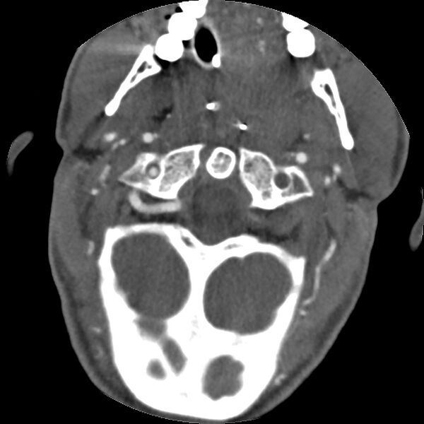File:Cervical spine fractures with vertebral artery dissection (Radiopaedia 32135-33078 D 67).jpg