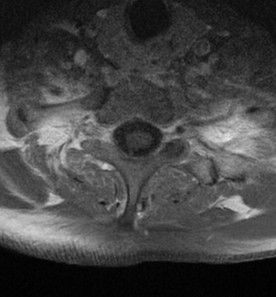 File:Cervical spondylodiscitis (Radiopaedia 81362-95110 Axial T1 C+ fat sat 18).jpg