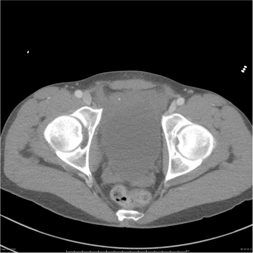 Chest and abdomen multi-trauma (Radiopaedia 26294-26426 A 82).jpg