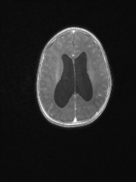 File:Chiari III malformation with occipital encephalocele (Radiopaedia 79446-92559 Axial T1 C+ mpr 59).jpg