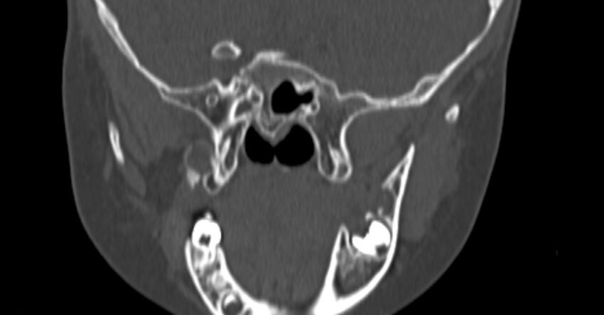 Choanal atresia (Radiopaedia 51295-56972 Coronal bone window 82).jpg