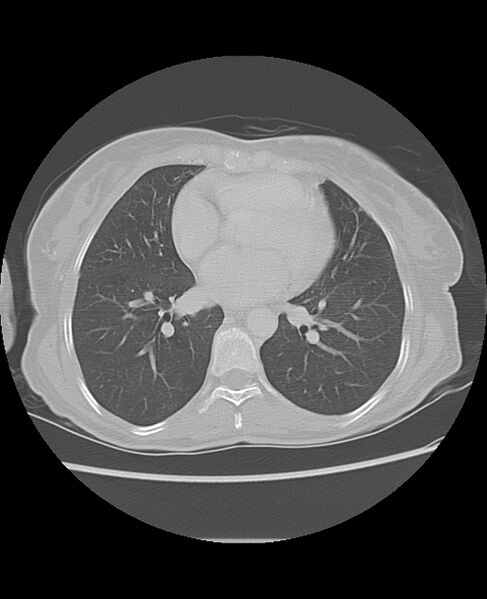 File:Chondrosarcoma (Radiopaedia 79427-92532 Axial lung window 34).jpg