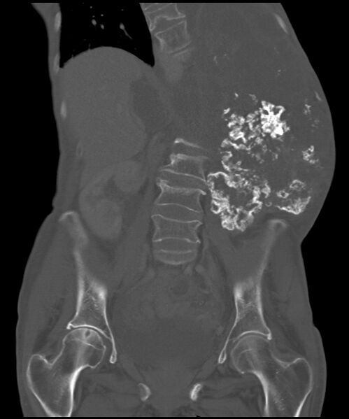 File:Chondrosarcoma of the spine (Radiopaedia 49871-55143 Coronal bone window 15).jpg