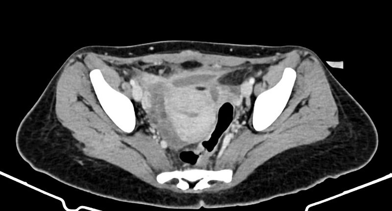 File:Choriocarcinoma liver metastases (Radiopaedia 74768-85766 A 176).jpg