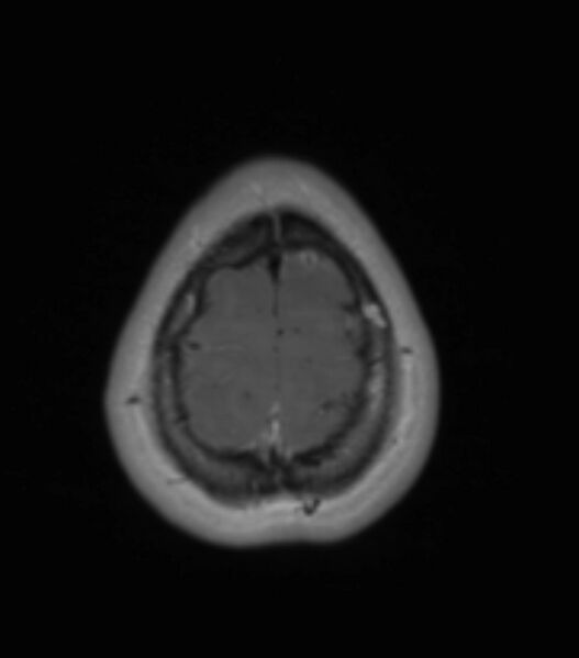 File:Choroid plexus carcinoma (Radiopaedia 91013-108553 Axial T1 C+ 196).jpg